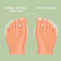 Fungus toenail infection vector medicine card. Colorful design. Detailed image with text.
